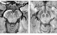 Black and white photo of deteriorating bones or tissue in Parkinsons Disease